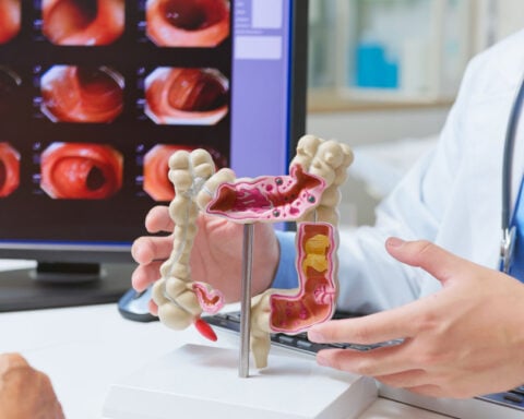 As more young people get screened, more colon cancer is being found early. Here’s how to lower your risk