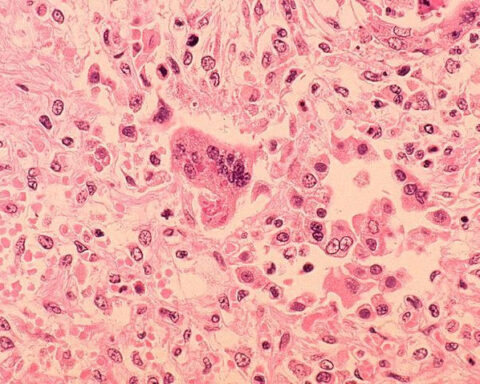 Los Angeles County child dies of rare measles complication years after infection