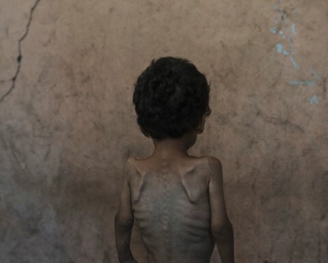 Nearly 55,000 children in Gaza under age 5 may be acutely malnourished, a new UN study finds