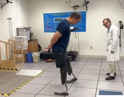 Double amputee wears backward-facing prosthetics; researchers hope method could help others