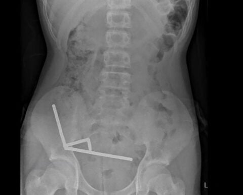 13-year-old boy hospitalized after swallowing dozens of high-powered magnets
