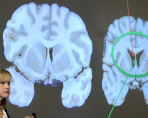 Hidden genetic damage is part of CTE, too, study finds