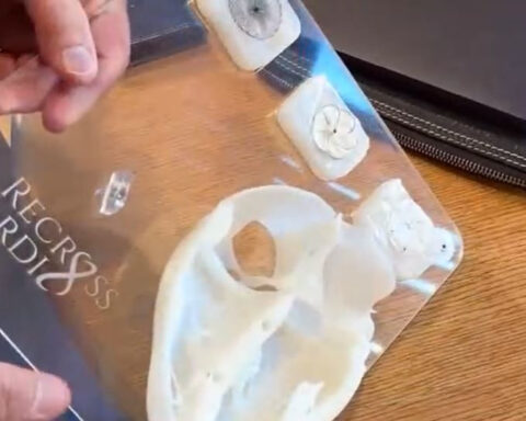 29-year-old stroke survivor is first in the world to try groundbreaking heart device