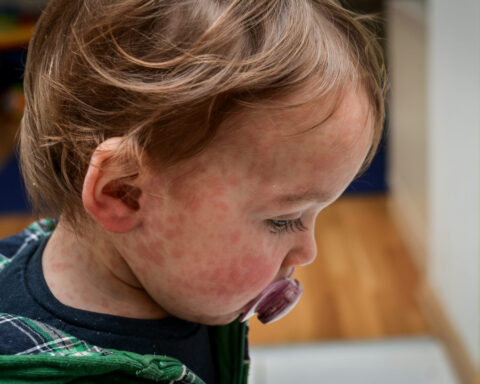 Canada loses its official ‘measles-free’ status – and the US will follow soon, as vaccination rates fall