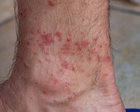 New Jersey man is first known death from meat allergy triggered by tick bites