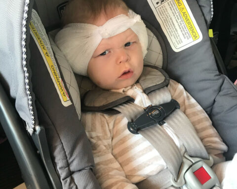 Babies as young as 7 months now have access to ‘transformative’ cochlear implants