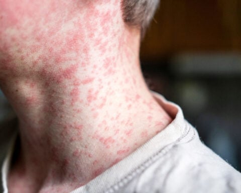 More than 2,000 measles cases reported in the US in 2025 as ongoing outbreaks threaten elimination status
