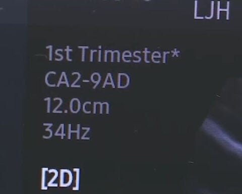 Alabama's robotic ultrasound plan raises concerns from OB-GYNs