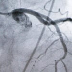 Experimental cholesterol-lowering pill may offer new option for millions