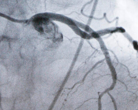 Experimental cholesterol-lowering pill may offer new option for millions