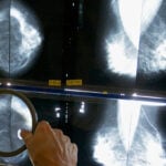Pandemic disruptions to health care worsened cancer survival, study suggests