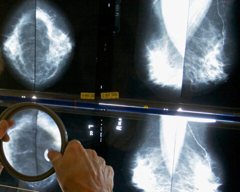 Pandemic disruptions to health care worsened cancer survival, study suggests