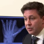 Man becomes one of the first patients to get new implant for arthritis