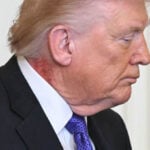 Trump’s neck rash is because of ‘preventative skin treatment,’ his doctor says