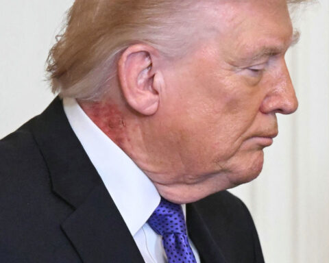 Trump’s neck rash is because of ‘preventative skin treatment,’ his doctor says