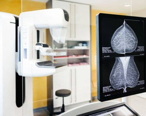 Global breast cancer cases expected to reach over 3.5 million by 2050