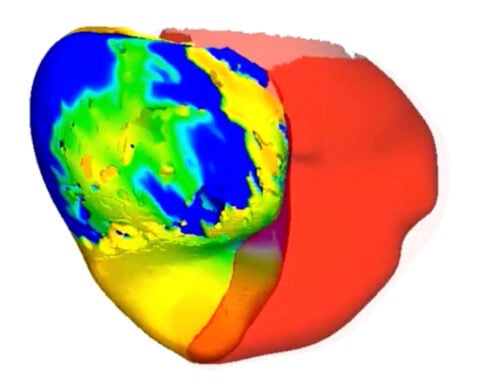 To fix a patient's irregular heartbeat, doctors first tested its digital 'twin'