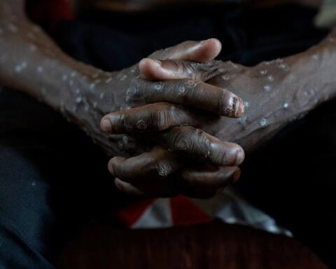 Congo says its mpox outbreak is over after 2 years and more than 2,200 suspected deaths