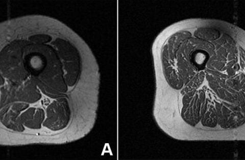 Ultraprocessed foods are turning human thighs into well-marbled steaks