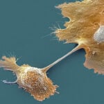 Breakthrough drug nearly doubles survival with advanced pancreatic cancer – an oncologist explains how daraxonrasib overcame an ‘undruggable’ disease