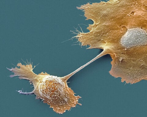 Breakthrough drug nearly doubles survival with advanced pancreatic cancer – an oncologist explains how daraxonrasib overcame an ‘undruggable’ disease