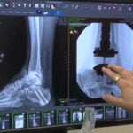 North Carolina grandfather has ankle totally replaced so he can walk with his grandson