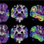 An experimental Alzheimer's drug shows some promise as researchers hunt new approaches