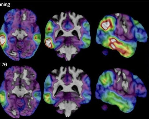 An experimental Alzheimer's drug shows promise targeting a different brain protein, new study shows
