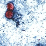 Outbreak of diarrhea from parasite expands to more states as US cases soar beyond last year’s level