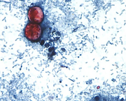 Outbreak of diarrhea from parasite expands to more states as US cases soar beyond last year’s level
