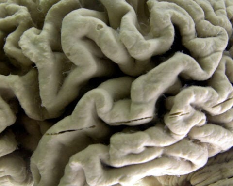 Study shows a blood test can help identify healthy people at high risk for Alzheimer's disease
