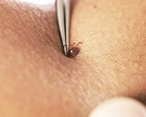 How to avoid tick bites in your yard or while hiking in the woods, and what to do if one starts feasting on you