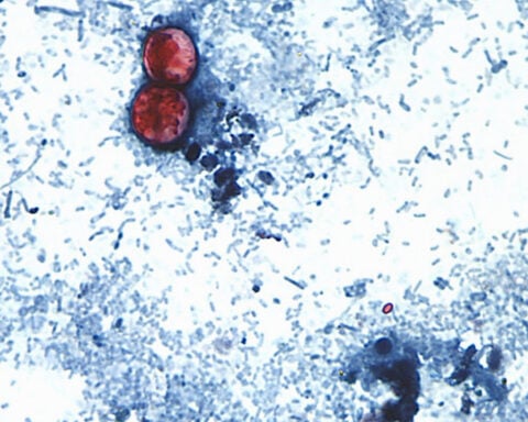 So you think you caught cyclospora, the diarrhea-causing parasite. Here’s what to do next