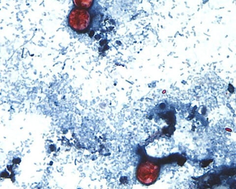 Massive cyclosporiasis outbreak linked to four more states