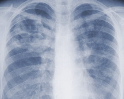 Study suggests the threat of mold-associated illnesses may be underappreciated