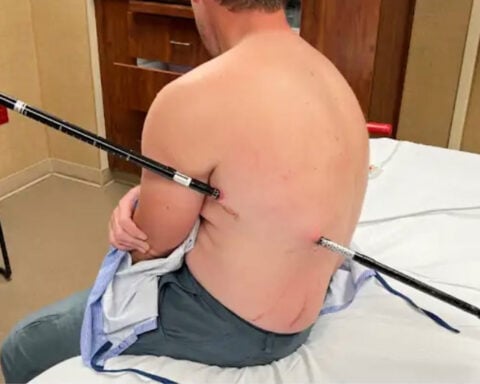 Montana man hikes out of the mountains to get help after he was impaled by a trekking pole