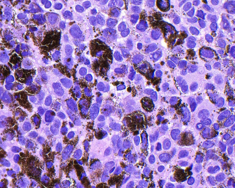 Moderna and Merck say melanoma vaccine succeeded in large trial