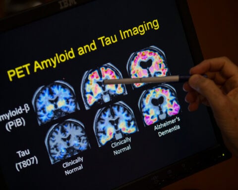 Want to lower your risk of dementia? It doesn't involve a blood test