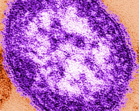 Adult woman dies of measles complications in growing Pennsylvania outbreak