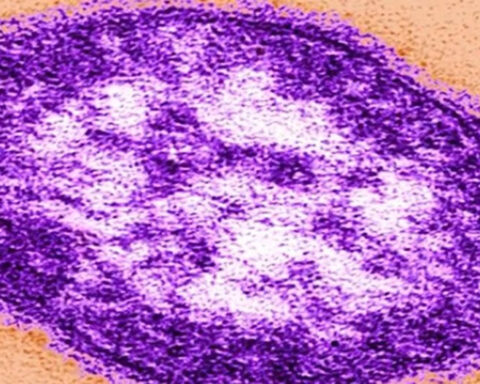5th measles-associated death reported in Pennsylvania, health officials say